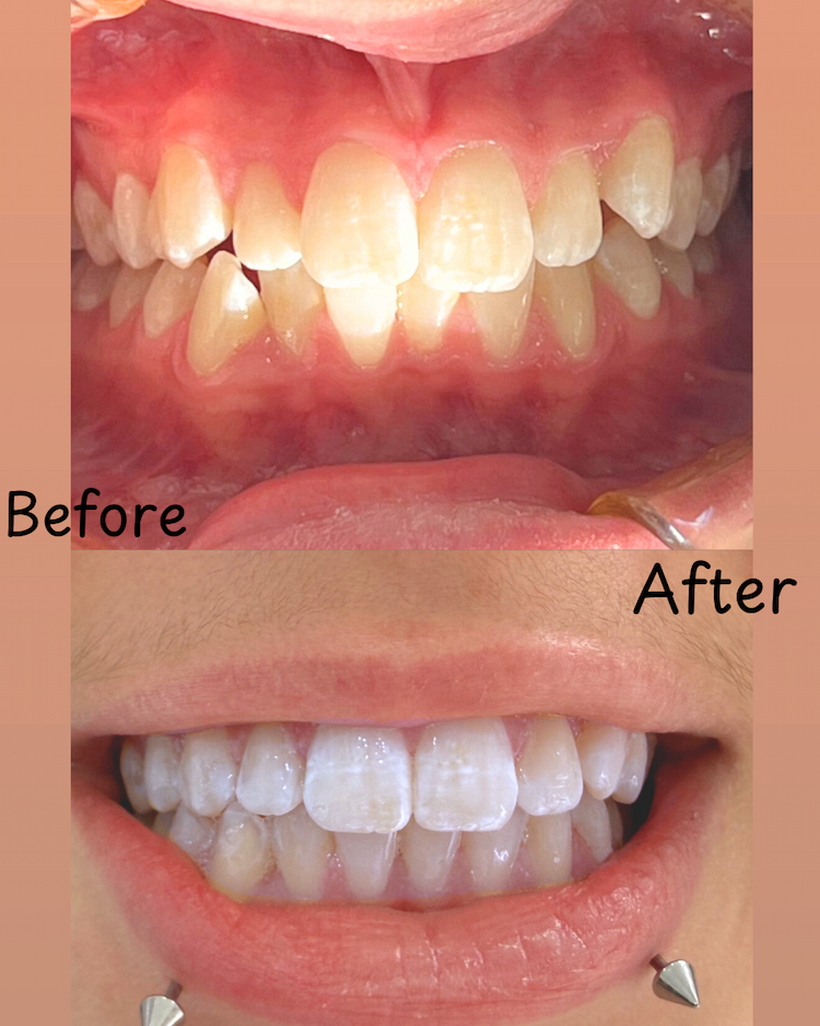 Before and after Invisalign result 1