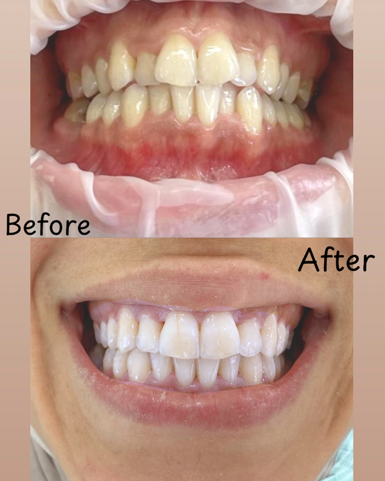 Before and after Invisalign result 2
